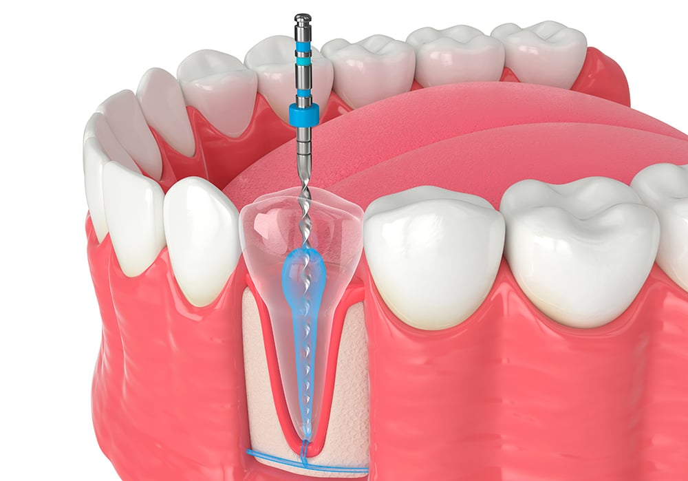 Infografía en 3D de la parte inferior de una dentadura en la que una sonda periodontal atraviesa una muela.