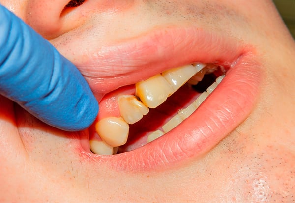 Dentadura de un paciente con caries dental