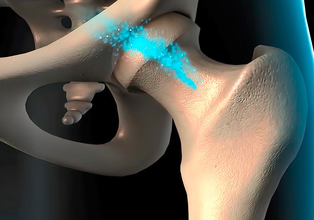 Recreación en una infografía en 3d de como la osteoporosis afecta al hueso del fémur.